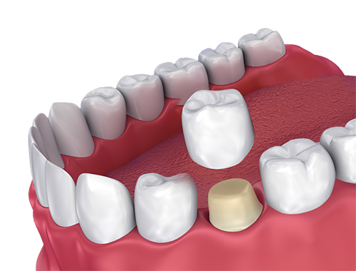 dental crown and bridges