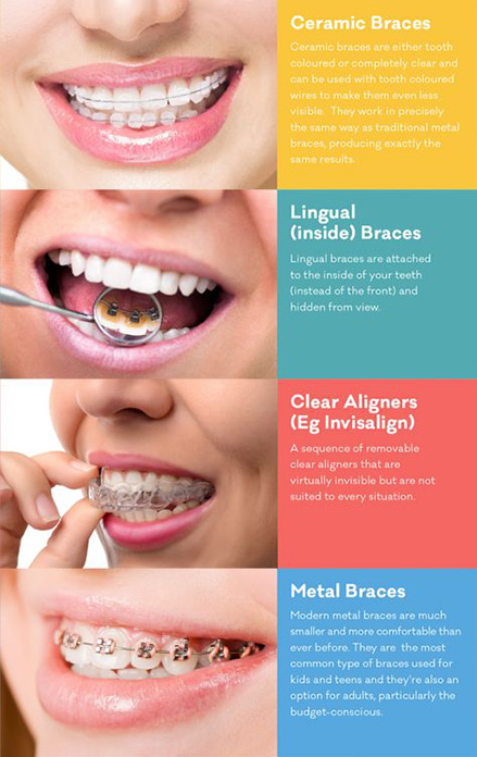 The 5 Common Types Of Braces and Their Cost