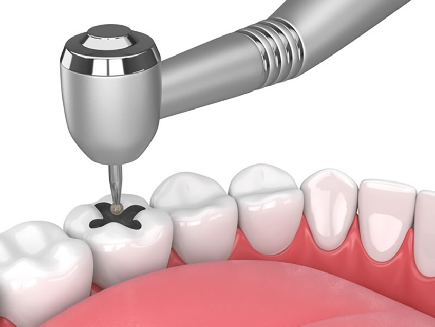 Dental Treatment Options for a Cracked Tooth - Columbia Advanced